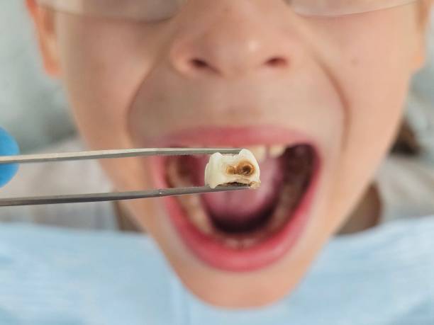 Best Emergency Tooth Extraction  in Brandermill, VA